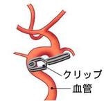 開頭手術（開頭クリッピング術）　Craniotomy procedure (art of open head clipping)